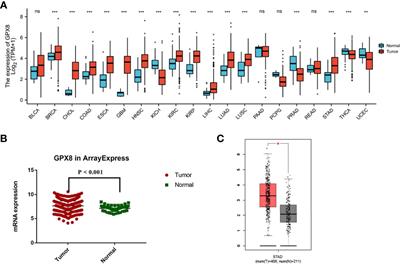 Immunohistochemistry and Bioinformatics Identify GPX8 as a Potential Prognostic Biomarker and Target in Human Gastric Cancer